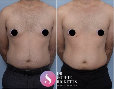 Gynecomastia Surgery before and after photo
