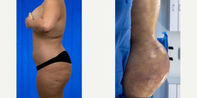 Laser Liposuction before and after photo