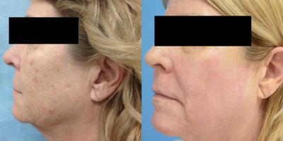 CO2 Laser before and after photo