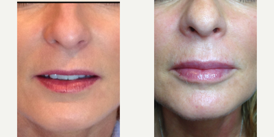 Dermal Fillers before and after photo