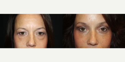 Eyelid Surgery before and after photo
