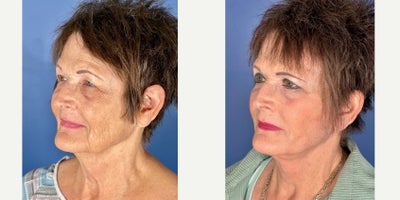 Eyelid Surgery before and after photo