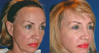 Facelift before and after photo