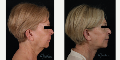 Facelift before and after photo
