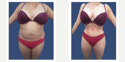 Liposuction before and after photo