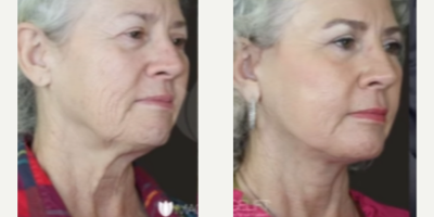 Sculptra before and after photo