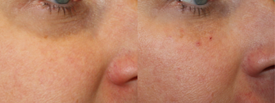 Belotero before and after photo