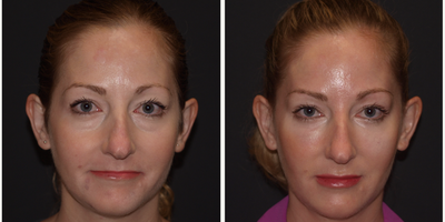 Facial Fat Transfer before and after photo