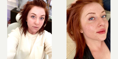 Lip Fillers before and after photo