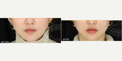 Lip Fillers before and after photo