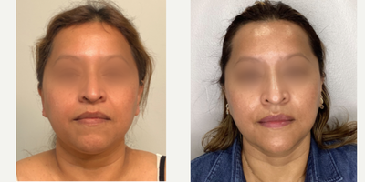 Radiesse before and after photo
