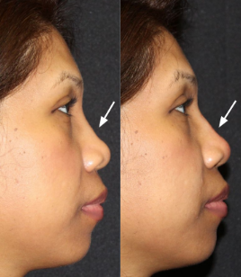 Dermal Fillers before and after photo