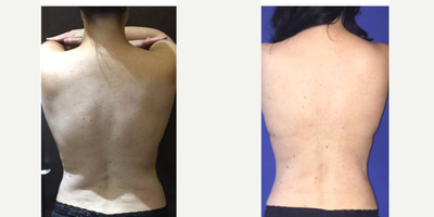 SculpSure before and after photo