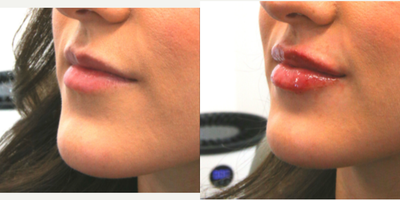 Lip Fillers before and after photo