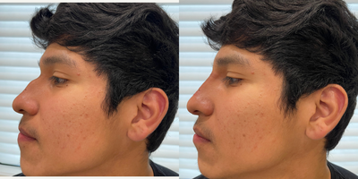 Nonsurgical Nose Job before and after photo