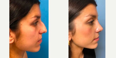 Rhinoplasty before and after photo