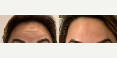 Botox before and after photo