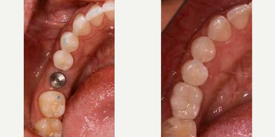 Dental Implants before and after photo