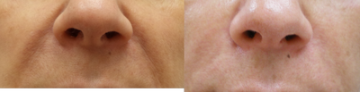 Juvederm before and after photo