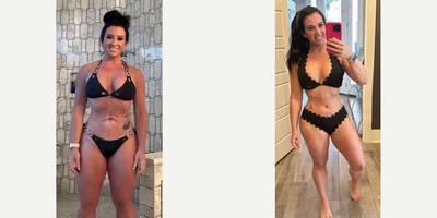 Tummy Tuck before and after photo