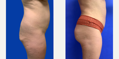 Brazilian Butt Lift before and after photo