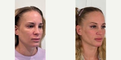 Eyelid Surgery before and after photo