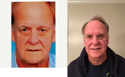 Facelift before and after photo