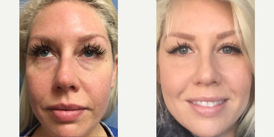 Fractora RF before and after photo