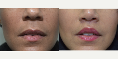 Lip Surgery before and after photo