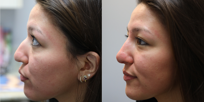 Nonsurgical Nose Job before and after photo