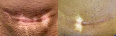 Scar Removal before and after photo