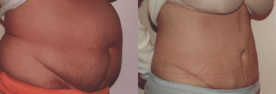 Tummy Tuck before and after photo