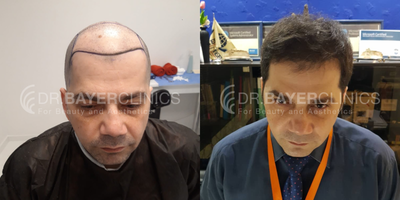 FUE Hair Transplant before and after photo