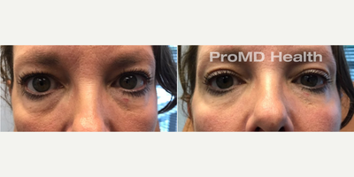 Hyaluronidase before and after photo