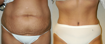 Tummy Tuck before and after photo