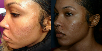 Bellafill before and after photo