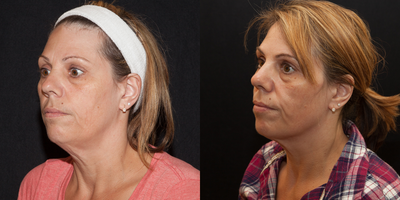 Kybella before and after photo