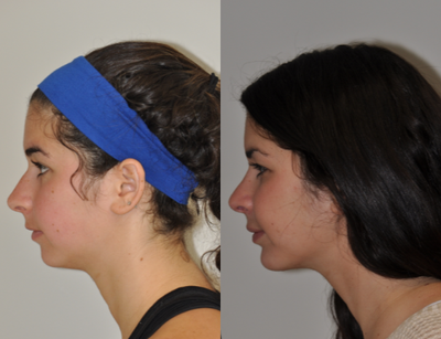 Chin Implant before and after photo