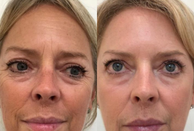 CO2 Laser before and after photo