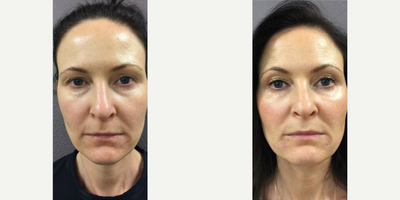 Infini RF before and after photo