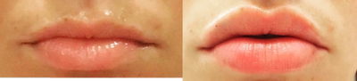 Juvederm before and after photo