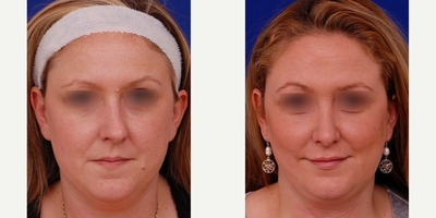 Revision Rhinoplasty before and after photo