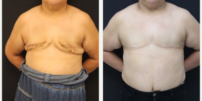 Breast Reconstruction before and after photo