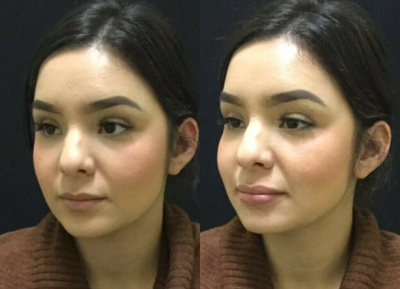 Lip Fillers before and after photo
