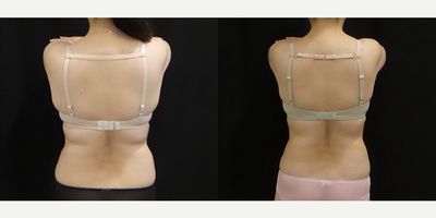 CoolSculpting before and after photo
