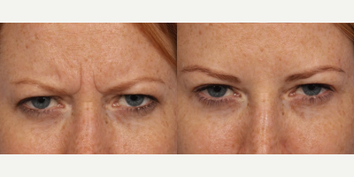 Dysport before and after photo