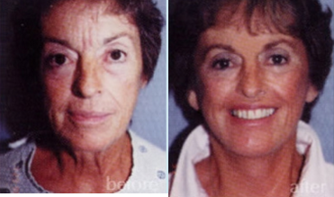 Facelift before and after photo