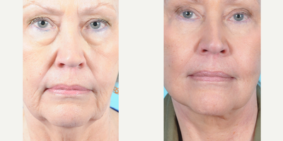 Facelift before and after photo
