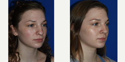 Septoplasty before and after photo