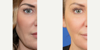 Botox before and after photo